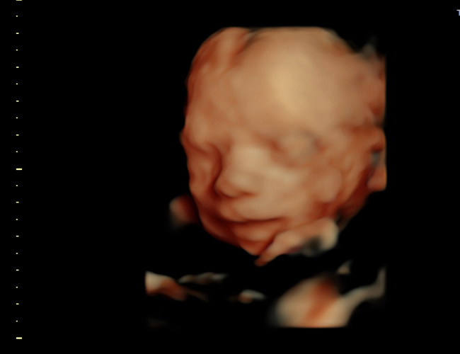 3D ultrasound image at 25 weeks